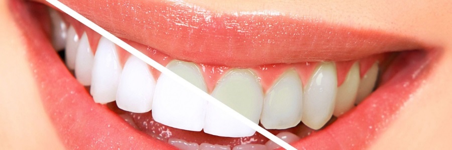 Best teeth whitening for enamel